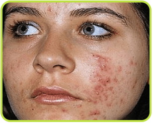 Acne Treatment in Jalandhar​