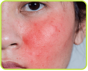 Acute Chronic Skin Problem​​ treatment