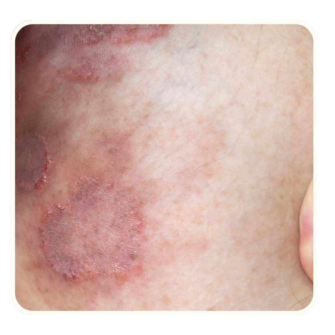 Ringworm Treatment in Jalandhar